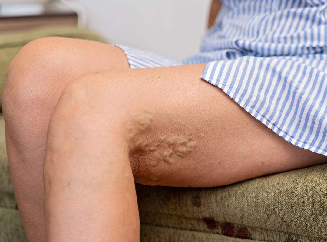 Jambe présentant un gonflement évocateur d'un trouble veineux