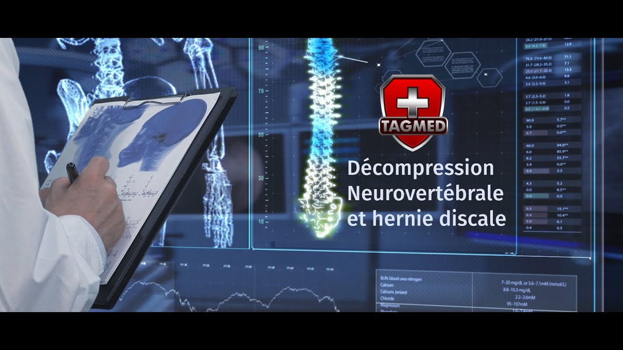 Schéma d'une hernie foraminale comprimant une racine nerveuse à la sortie de la colonne vertébrale